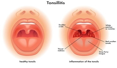 8 Home Remedies To Remove Tonsil Stones